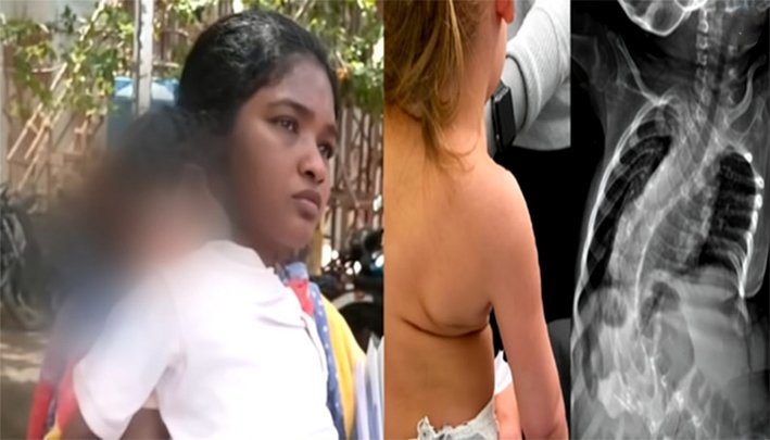 2 வயது குழந்தைக்கு அரிய மரபணு நோய்- ரூ.16 கோடி மருந்து தேவை