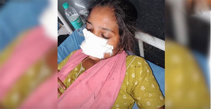 குடும்ப தகராறில் கொடூரம்… மனைவியின் மூக்கை கடித்த கணவன்!