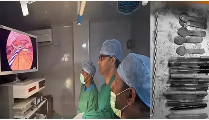 அதிர்ச்சி ஆபரேஷன்…பெண் வயிற்றில் இருந்த 19 பொருட்கள் அகற்றம்